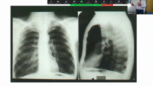 17-11-23-DFASM1-pneumo allergo (bpco)F Wassmer.mp4