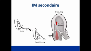 Fuite Mitrale - Mécanismes et opérabilité - Dr THERON_1