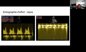 Cas cliniques interactif valvulopathie mitrale