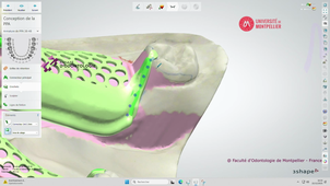 3SHAPE2025_PPAM MD 05 calage & crochets.mp4