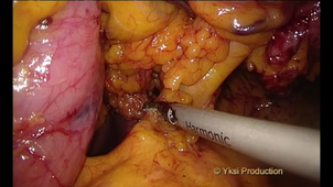 VIDEO Oesophagectomie coelioscopie-thoracoscopie