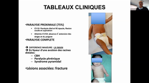 DU de chirurgie plastique pédiatrique Pr Franck Noel Fitoussi paralysie congénital du plexus brachial 04/02/2021
