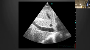 XB ECHO CARDIAQUE TRANS THORACIQUE .mp4