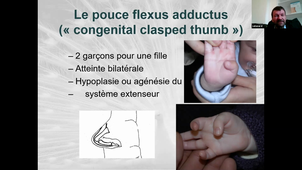 DU de chirurgie plastique pédiatrique Dr Salazar, Défaut de différenciation et hypertrophie des extrémités 03/12/2020