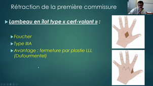 Hypoplasie du pouce - Dr Abid (DUC de CPP)  (03/12/2020)