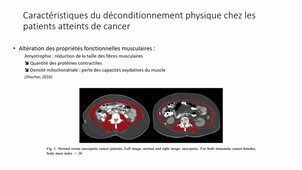 L'activité physique adaptée en oncologie