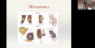 DFASM1 MIB 17/11/2020 Syndrome occlusif. Invagination intestinale, Hernie pariétale de l'adulte	FR. SOUCHE