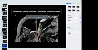 Evaluations IRM des cardiomyopathies hypertrophiques - Dr MEILLE