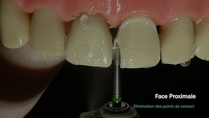 Préparation périphérique pour tout céramique sur dent antérieur