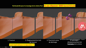 2024_Fracture simple01_Protocole de réparation.mp4