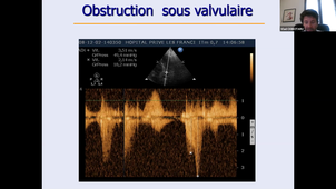 Prothèses valvulaires - Dr CIOBOTARU