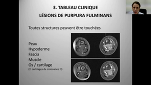 DU de chirurgie plastique pédiatrique Dr Anissa Belkhou, Purpura de l'enfant 03/02/2021