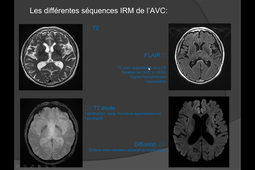 03-2019-2020-collemiche-imagerie-accidents-vasculaires-cerebraux-duo-video
