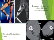 DU Lymphologie - Lymphoedeme primaire