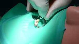 Cas clinique sur prémolaire