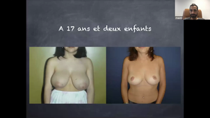 DU de chirurgie plastique pédiatrique Pr Chaput, Le sein de l'adolescente 03/12/2020