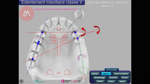 Tracé maxillaire classe II_V4x