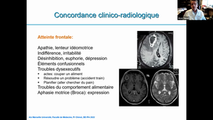 Classe virtuelle - Tumeurs cérébrales (Pr O. Chinot, CHU de Marseille)