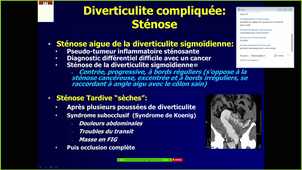 DFASM1 MIB (27/10/2020) B. AL TAWEEL - Diverticulose colique et sigmoïdite /Tumeurs de l'estomac et de l'œsophage