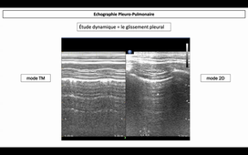 DR MARKARIAN ECHO PULMO 1.mp4