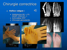 Dr. Cellier - Place de la chirurgie orthopédique