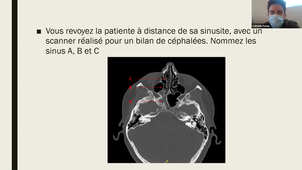 DFASM1 MID 26/01/21 Epistaxis, Infections naso sinusiennes de l'adulte. Tumeurs naso sinusiennes et du cavum V-FAVIER salle 302