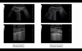 DR MARKARIAN CC + ECHO DIAPH.mp4