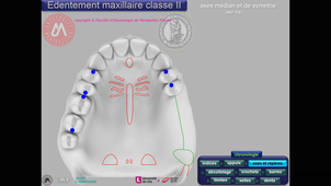 Tracé maxillaire classe II