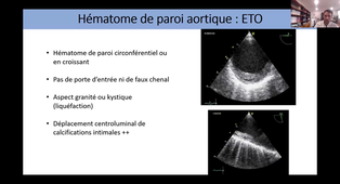 ETO et pathologie aortique- Dr ARREGLE.mp4