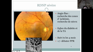 DFASM1 MID (13/11/2020) rétine regroupe DMLA, RD - Anomalie de la vision d'apparition brutale. P.PINEAU