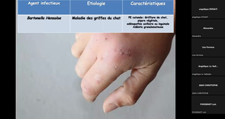 Classe virtuelle - Pathologies malignes lymphoïdes (Dr C. Bagacean, CHU de Brest)