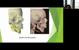 DU de chirurgie plastique pédiatrique Dr Eva Galliani, Microsomie craniofacial et dysostose faciale 03/02/2021