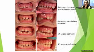 DU CPP - Pr. Gallianni - Microsomie hémifaciale et syndrome de Franceschetti
