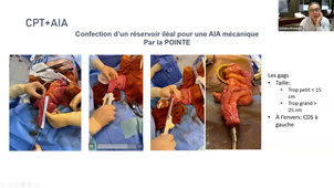 Génétique et cancers digestifs_Pr BROUQUET.mp4