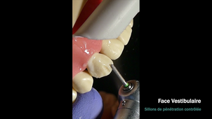 Préparation périphérique sur canine maxillaire