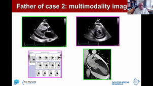 Cardiomyopathies restrictives - Cas clinique - Pr HABIB et Dr MARTEL