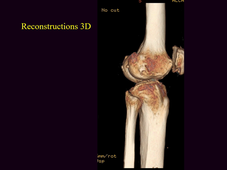 Sémiologie élémentaire en imagerie - Osteo articulaire - Pr Catherine CYTEVAL