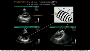 DIU TMUS / Dr Muller Echographie cardiaque et péricardique 1