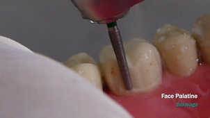 Préparation molaire maxillaire pour céramo-métallique