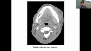 (06/11/2020) 16h M- DE BOUTRAY / A- DAMECOURT salle 302 MID Traitement des cancers : principales modalités, classes thérapeutiques et leurs complications majeures - Tumeurs de la cavité buccale- Tumeurs épithéliales