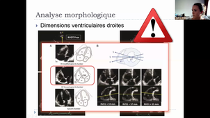 Fonctionnement Systolique du Ventricule droit - Dr AGULLO