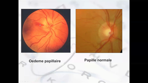 27/04/2021	8:00	10:00	MID rétine regroupe DMLA, RD - Anomalie de la vision d'apparition brutale.	P-PINEAU	ziegelman	https://umontpellier-fr.zoom.us/j/8057374180	mid