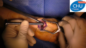 Prothèse Trapézo-métacarpienne par voie antérieure.mp4