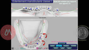 Tracé classe I mandibulaire (vitesse accélérée)