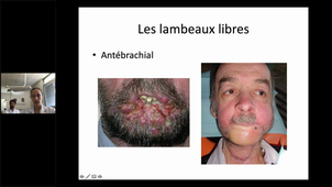DU Microchirurgie - M. DE BOUTRAY - Reconstrucion par lambeaux libres en chirurgie cervico-faciale