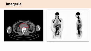 Les lymphomes_Pr E. GYAN