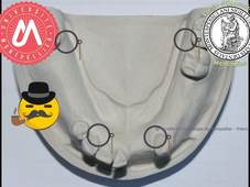 J4c_PEI mandibulaire totalement espacé_butées d'enfoncement