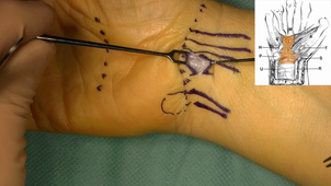Chirurgie endoscopique du syndrome du canal carpien. Pr Michel CHAMMAS
