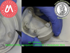 J3a_PEI mandibulaire partiellement ajusté_tracé des limites