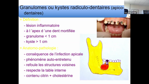 DU de chirurgie plastique pédiatrique 14h à 14h50, Pr Gleizal, Kystes et tumeurs maxillo faciales 07/04/2021